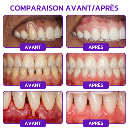 Dentifrice thérapeutique Rolimey® VioCore au venin d’abeille contre la gingivite et la parodontite