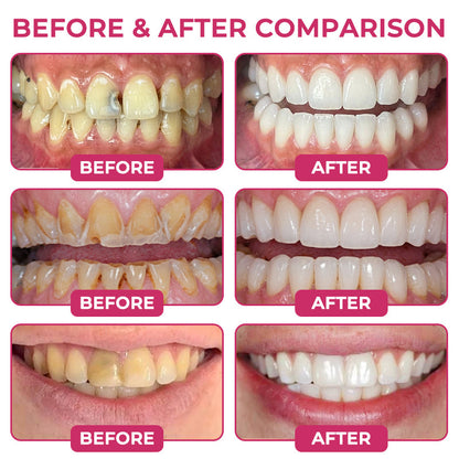 ⭐️Rolimey® DenPerm : gel de restauration de l'émail naturel pour la réparation des caries