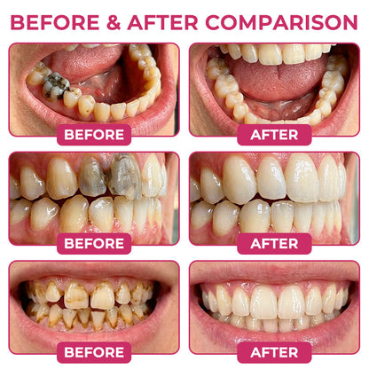 ⭐️Rolimey® DenPerm : gel de restauration de l'émail naturel pour la réparation des caries